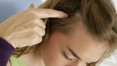 أسباب فطريات الشعر وكيفية علاجها