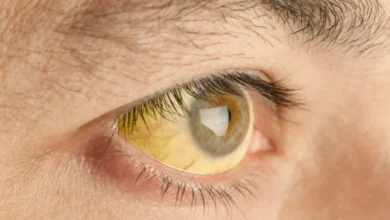 اصفرار الجسم.. 5 أسباب قد تكون وراء حدوث هذه الحالة