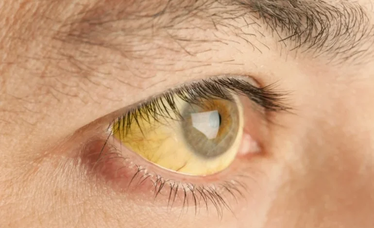 اصفرار الجسم.. 5 أسباب قد تكون وراء حدوث هذه الحالة