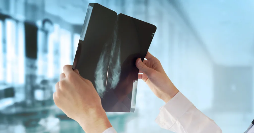 ضرورة فحص الثدي باستخدام أشعة الماموغرام كل عامين