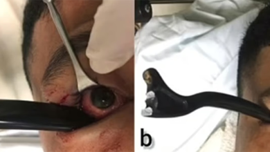 بعملية جراحية دقيقة.. شاهد ما استخرجه الأطباء من عين هذا الرجل