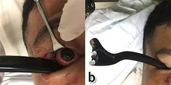 بعملية جراحية دقيقة.. شاهد ما استخرجه الأطباء من عين هذا الرجل