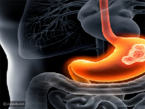 دليل غذائي لمرضى التهاب المعدة