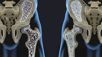 أعراض هشاشة العظام